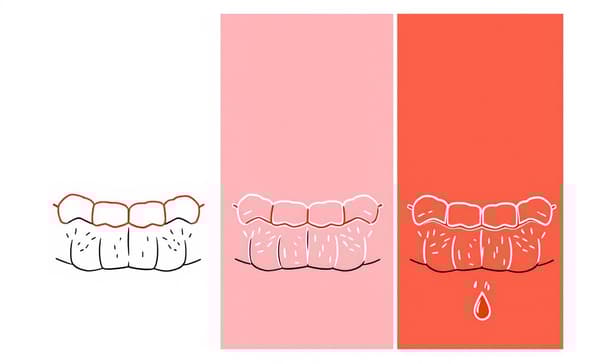 洗牙流血是牙齦發炎警訊？了解出血原因與日常改善要點
