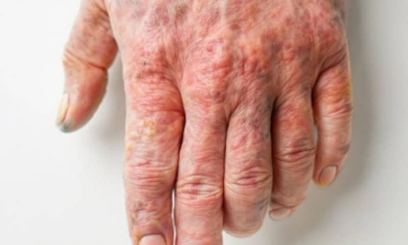 psoriasis-arthritis-solutions