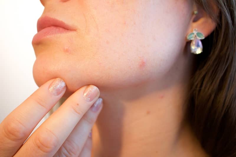 scalp-acne-causes-prevention-treatment