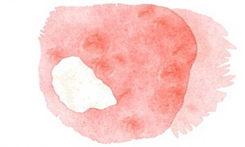 無法刮除的白色斑塊，需要特別留意